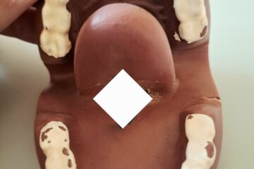 rana po podcięciu wędzidełka